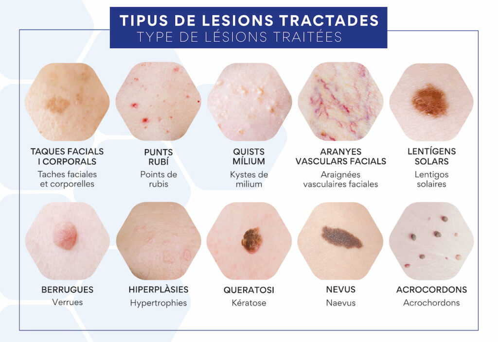 types de blessures traitées au Blue Laser