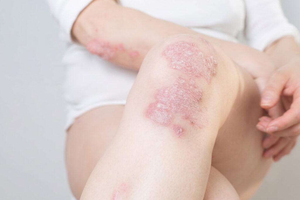 depilacio laser psoriasis