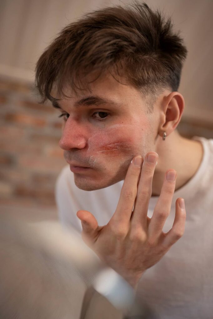 laser afeccions pell rosacea